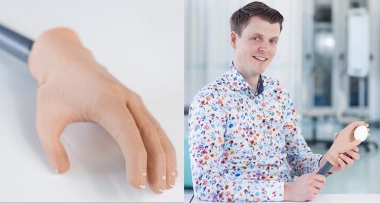 Deze handprothese kan dingen vastpakken afbeelding nieuwsbericht